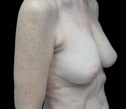 Breast Revision Before & After Patient #16568
