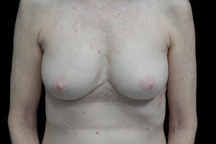 Breast Revision Before & After Patient #16568