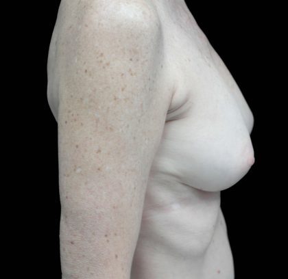 Breast Revision Before & After Patient #16568