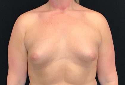 Breast Augmentation (Implants) Before & After Patient #16403