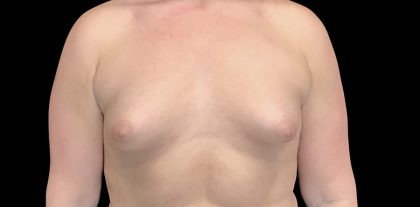 Breast Augmentation (Implants) Before & After Patient #16403