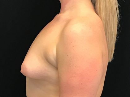 Breast Augmentation (Implants) Before & After Patient #16403