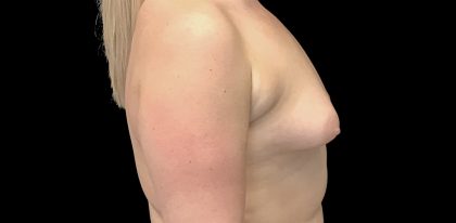 Breast Augmentation (Implants) Before & After Patient #16403