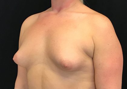 Breast Augmentation (Implants) Before & After Patient #16403