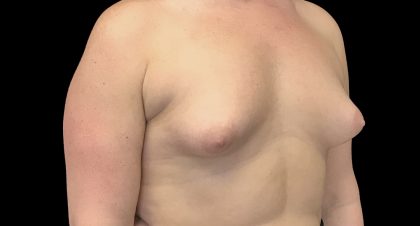 Breast Augmentation (Implants) Before & After Patient #16403