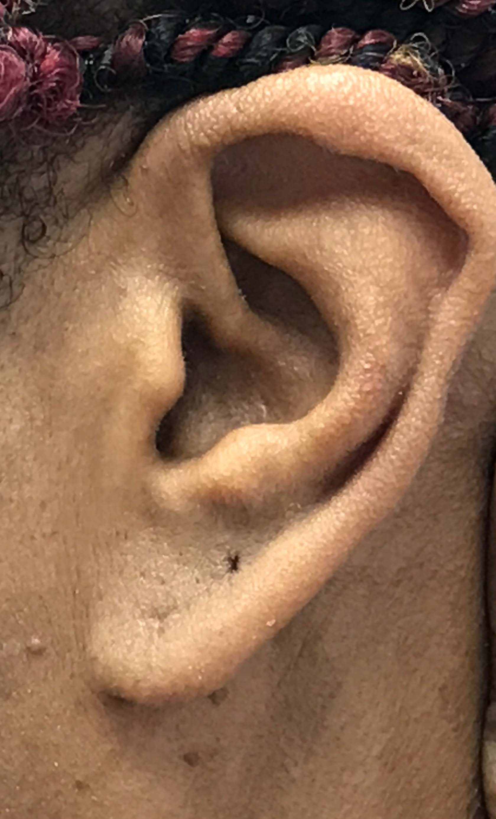Earlobe Repair Before & After Patient #16473