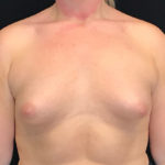 Breast Augmentation (Implants) Before & After Patient #16403