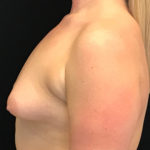 Breast Augmentation (Implants) Before & After Patient #16403