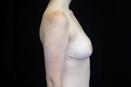 Breast Reduction Before & After Patient #16439