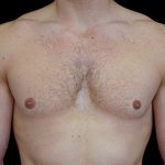 Gynecomastia Before & After Patient #16519