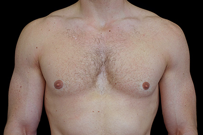 Gynecomastia Before & After Patient #16519