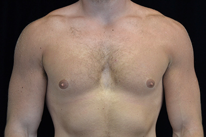 Gynecomastia Before & After Patient #16519