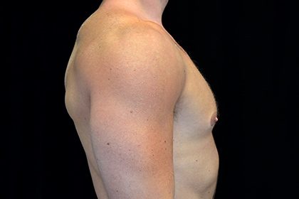 Gynecomastia Before & After Patient #16519