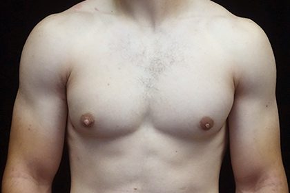 Gynecomastia Before & After Patient #16526
