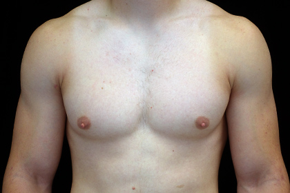Gynecomastia Before & After Patient #16526