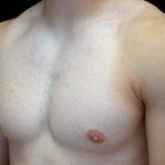 Gynecomastia Before & After Patient #16526