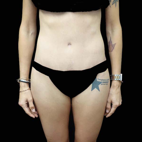 Lipoabdominoplasty Before & After Patient #16546