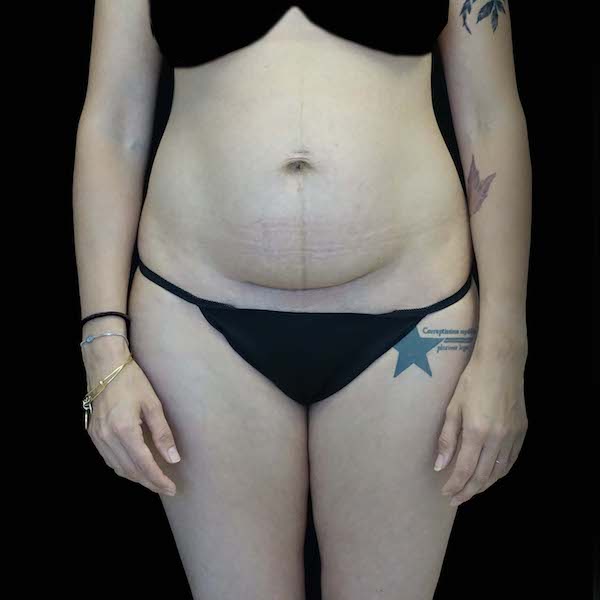 Lipoabdominoplasty Before & After Patient #16546