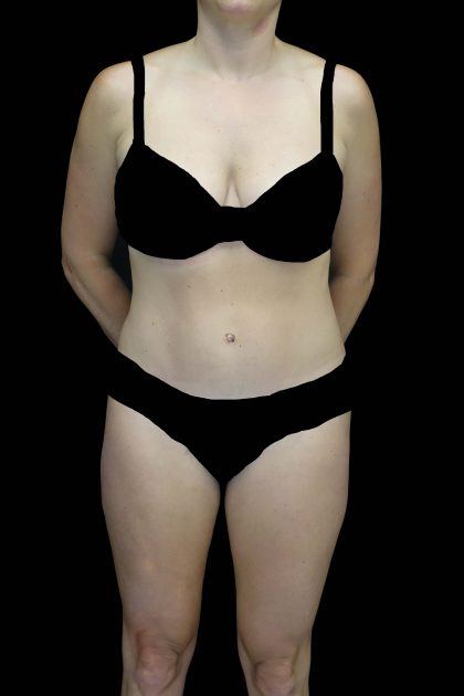 Tummy Tuck Before & After Patient #16587