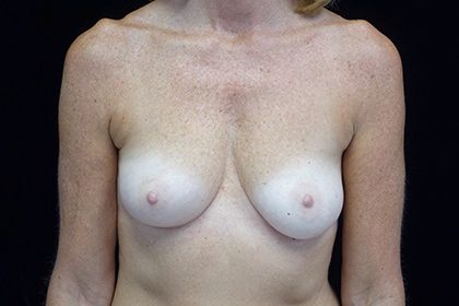 Asymmetric Tuberous Breasts Before & After Patient #16747
