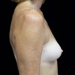 Asymmetric Tuberous Breasts Before & After Patient #16747