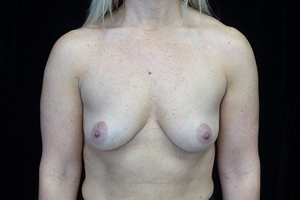 Asymmetric Tuberous Breasts Before & After Patient #16740