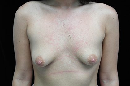 Asymmetric Tuberous Breasts Before & After Patient #16730