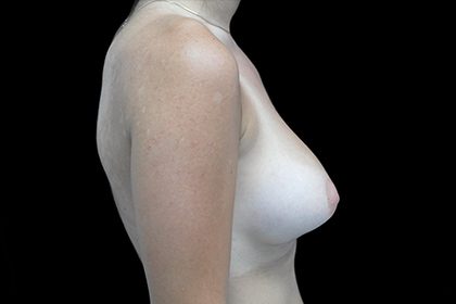 Asymmetric Tuberous Breasts Before & After Patient #16730