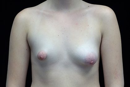 Asymmetric Tuberous Breasts Before & After Patient #16723