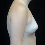 Asymmetric Tuberous Breasts Before & After Patient #16723