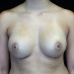 Asymmetric Tuberous Breasts Before & After Patient #16716