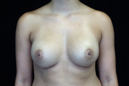 Asymmetric Tuberous Breasts Before & After Patient #16716