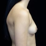 Asymmetric Tuberous Breasts Before & After Patient #16716