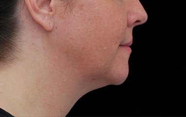 CoolSculpting Before & After Patient #16814