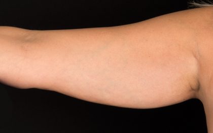 CoolSculpting Before & After Patient #16826