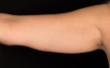 CoolSculpting Before & After Patient #16826