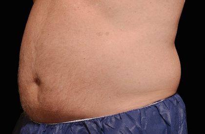 CoolSculpting Before & After Patient #16825