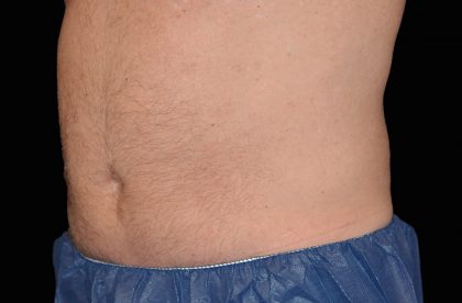 CoolSculpting Before & After Patient #16825