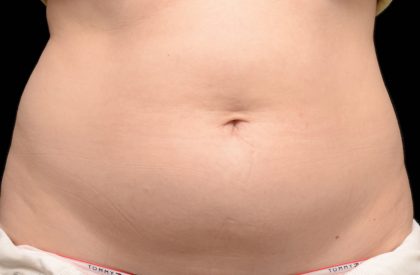 CoolSculpting Before & After Patient #16827