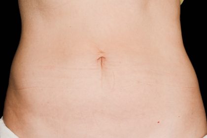 CoolSculpting Before & After Patient #16827