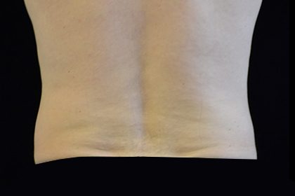CoolSculpting Before & After Patient #16829