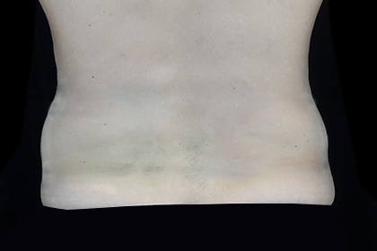 CoolSculpting Before & After Patient #16829