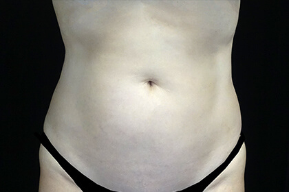 CoolSculpting Before & After Patient #16832