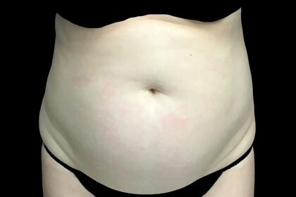 CoolSculpting Before & After Patient #16832