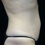 CoolSculpting Before & After Patient #16832