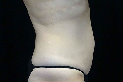 CoolSculpting Before & After Patient #16832