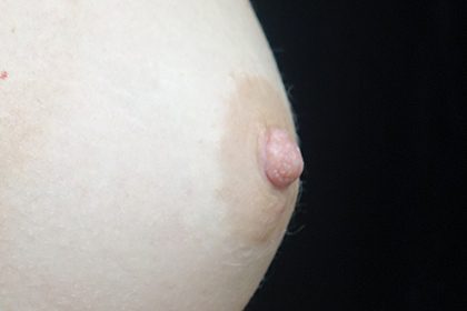 Nipple Inversion Before & After Patient #16857