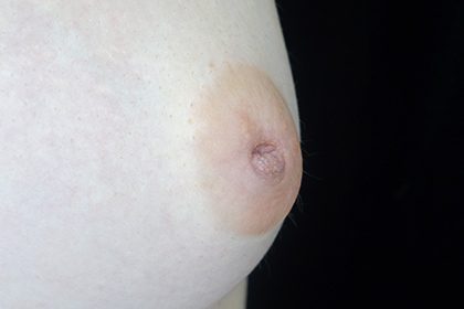 Nipple Inversion Before & After Patient #16857