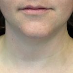 Kybella Before & After Patient #16852