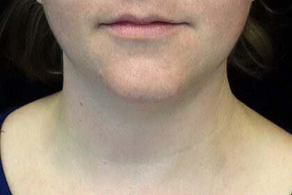 Kybella Before & After Patient #16852